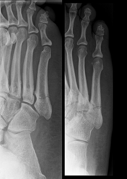 File:Jonesfracture.jpg