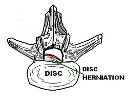 Can L4 and L5 spinal stenosis be cured?