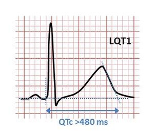 Long QT on an ECG. (Wikimedia Commons)