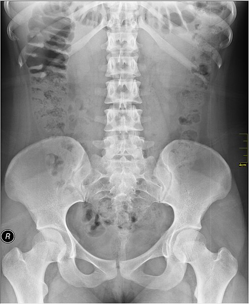 File:Medical X-Ray imaging TTJ07 nevit.jpg