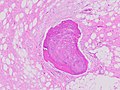Fig. 1 Micrograph of bone formation in a liposarcoma tumor