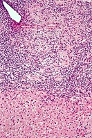 Intermediate magnification micrograph of PBC showing bile duct inflammation and periductal granulomas. Liver biopsy. H&E stain.