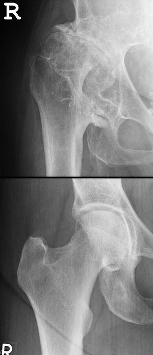 Hüftdysplasie: Pathomechanismus, Risikofaktoren und Epidemiologie, Diagnostik