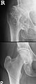 Im oberen Röntgenbild eines menschlichen Hüftgelenkes erkennt man die deutlichen Veränderungen durch eine Hüftgelenksarthrose bei Hüftdysplasie. Es finden sich im Randbereich des Gelenkes mehrere Osteophyten. Im unteren Bild ist zum Vergleich das Röntgenbild eines gesunden Hüftgelenkes abgebildet.