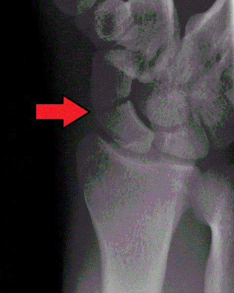File:Scaphoid waist fracture.gif
