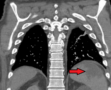 Splenic infarct seen on CT SplenicInfarctUpMark.png