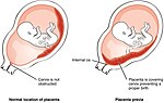 Miniatura per Placenta prèvia