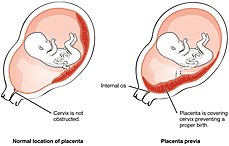Placenta prèvia - Viquipèdia, l'enciclopèdia lliure