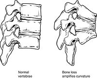 Collapse of vertebra on the right, normal on the left