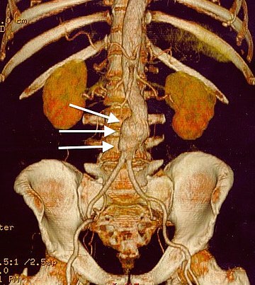 Aneurisma dell'aorta addominale