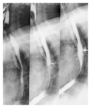 <span class="mw-page-title-main">Pulmonary aspiration</span> Entry of materials into the larynx (voice box) and lower respiratory tract