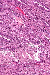 Atypical polypoid adenomyoma Human disease