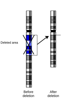 A schematic representation of a chromosome deletion. DECIPHER maps small deletions detected in patients to the reference genome produced by the Human Genome Project. Deletion of chromosome section.svg