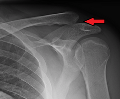 Type 3 AC joint separation on plain X ray