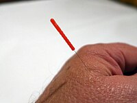 Hand acupuncture.jpg