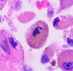 Histopatologi av en røykeres makrofag.jpg