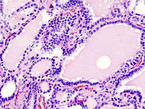 Дифузна гіперплазія тканини щитоподібної залози, що характерно для гіпертиреозу (фарбування гематоксиліном-еозином)