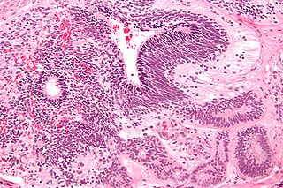 Immature teratoma Medical condition