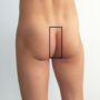 Thumbnail for Intergluteal cleft