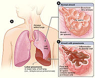 Lobar pneumonia illustrated.jpg