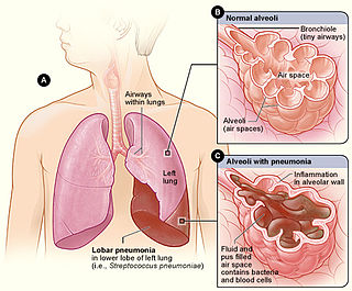 Lobar pneumonia Medical condition