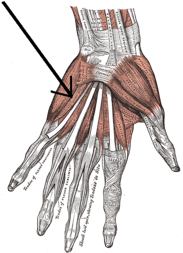 Flexor digiti minimi brevis muscle of hand