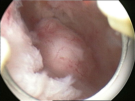 Submucosal fibroid in hysteroscopy