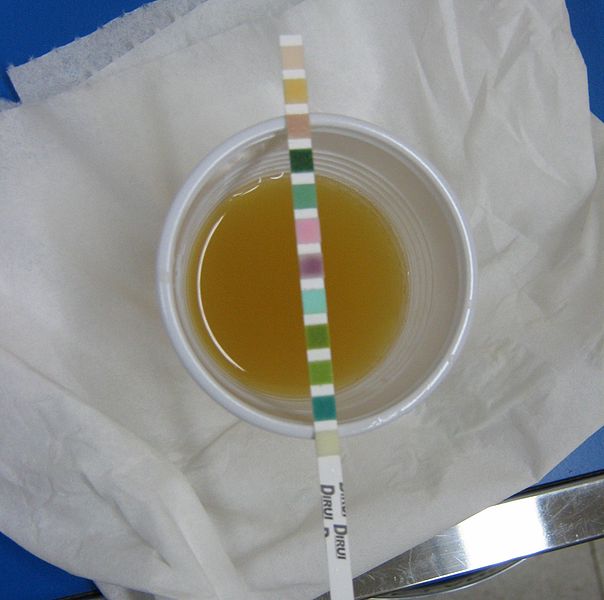 File:Urine trouble - BU sang nitrite leucocyte.jpg