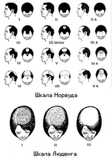 Alopecia scales.jpg