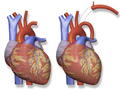 Blalock–Thomas-Taussig Shunt – left subclavian artery to left pulmonary artery.