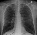 Lung bulla as seen on CXR in a person with severe COPD