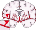 Hemorrhagic stroke