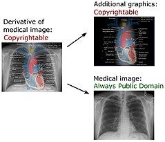 An example of a permitted combination of two works, one being CC BY-SA and the other being Public Domain Derivative of medical imaging.jpg