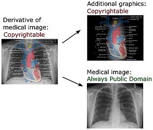 In U.S. law, this derivative work of a chest radiograph (which is in the Public Domain) is copyrightable because of the additional graphics. Yet the chest radiograph component of the work is still in the Public Domain. Derivative of medical imaging.jpg