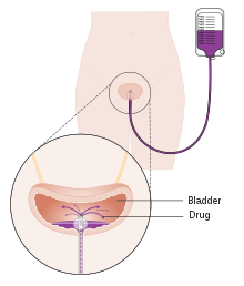 Drug treatment (chemotherapy) into the bladder(Intravesical) Diagram showing drug treatment into the bladder CRUK 114.svg
