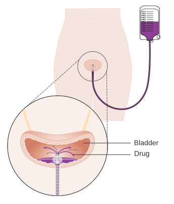 File:Diagram showing drug treatment into the bladder CRUK 114.svg