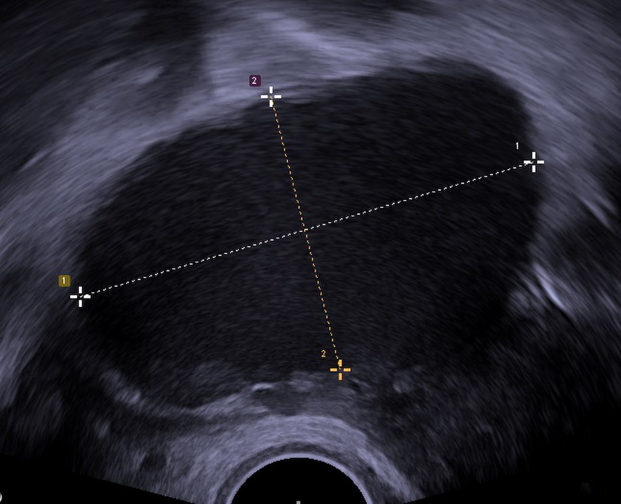 Quiste endometrial