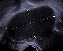 Transvaginal ultrasonography showing a 67 x 40 mm endometrioma as distinguished from other types of ovarian cysts by a somewhat grainy and not completely anechoic content Endometrioma.jpg