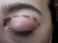 Eyelid surgery outline.jpg