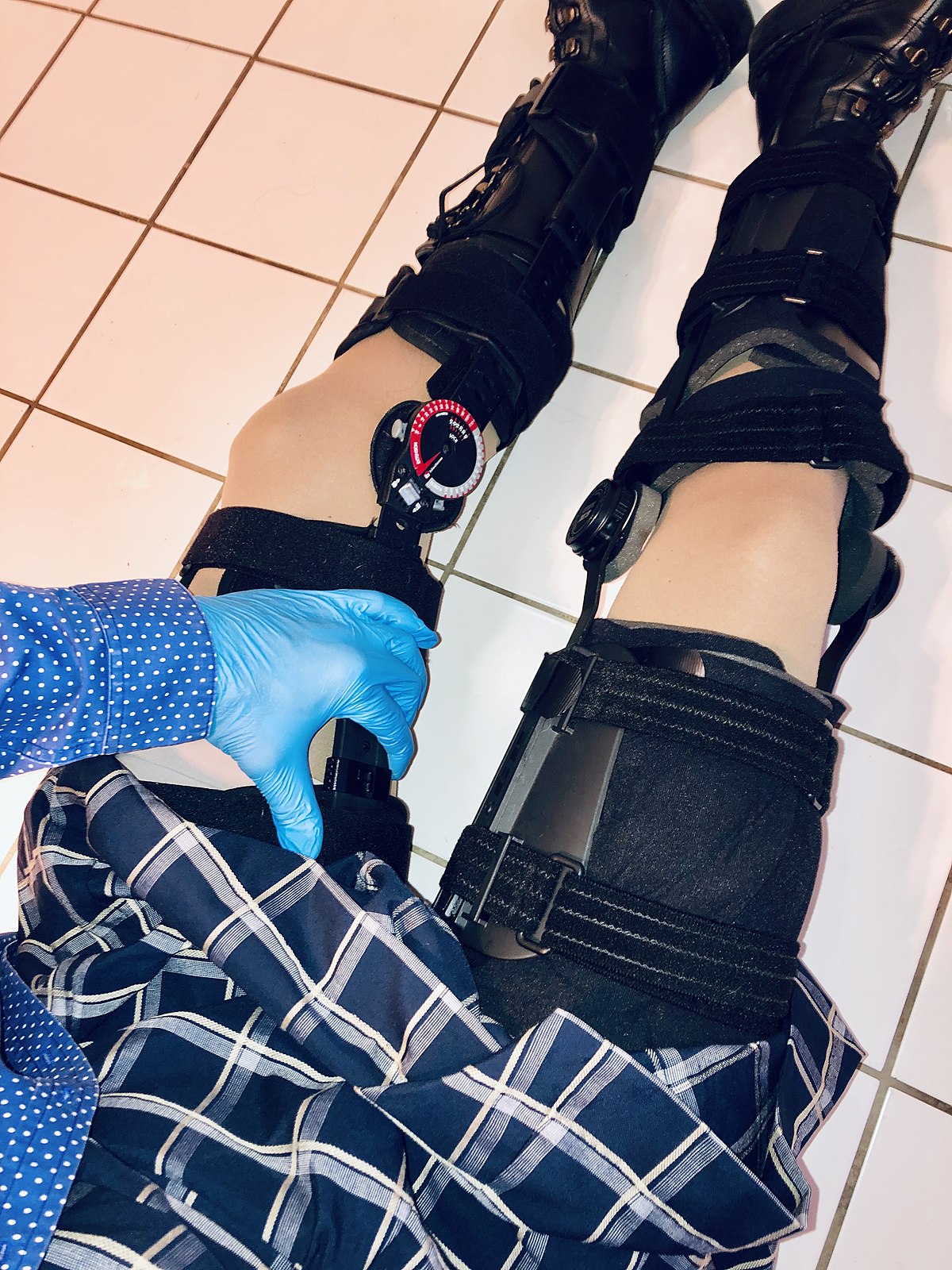 File:Full leg braces - adolescent female patient 1.jpg - Wikimedia Commons