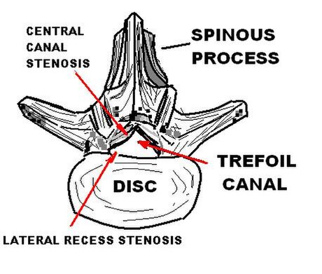 Spinal stenos