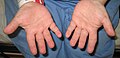 Hands of a person with Langer–Giedion syndrome showing the characteristic short fingers