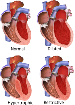 Major categories of cardiomyopathy