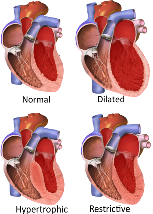 Major categories of cardiomyopathy