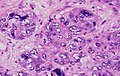 Micrograph of invasive ductal carcinoma with marked nuclear pleomorphism.jpg