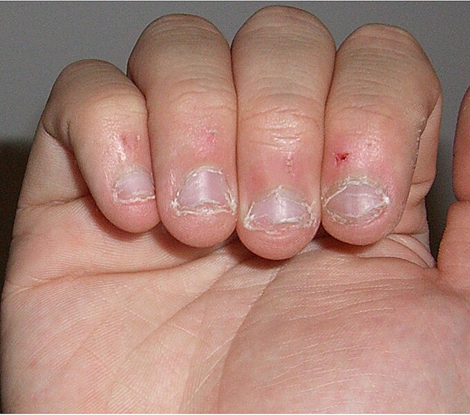 File:Nailbitebad.jpg