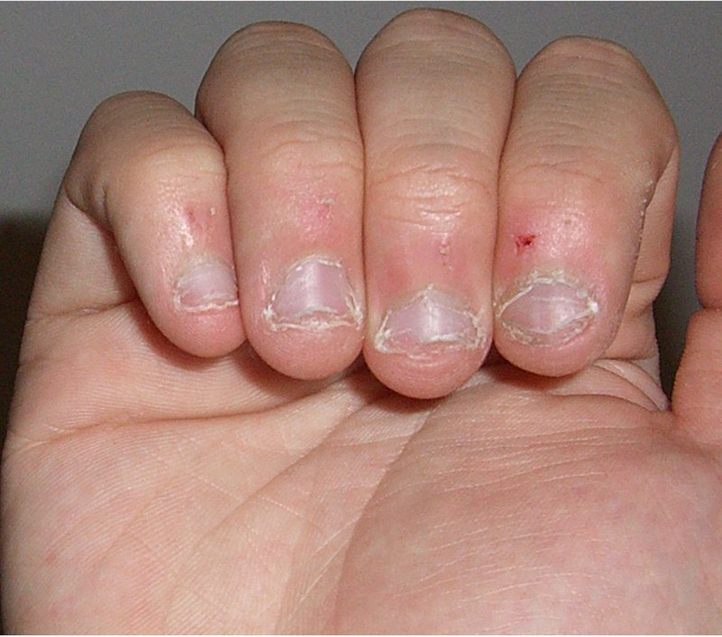 Anxiety and Compulsive Nail Biting-totobed.com.vn