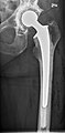 Hip prosthesis - anteroposterior (AP) view
