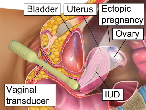 Transvaginal ultrasonography of an ectopic pregnancy, showing the field of view in the following image.