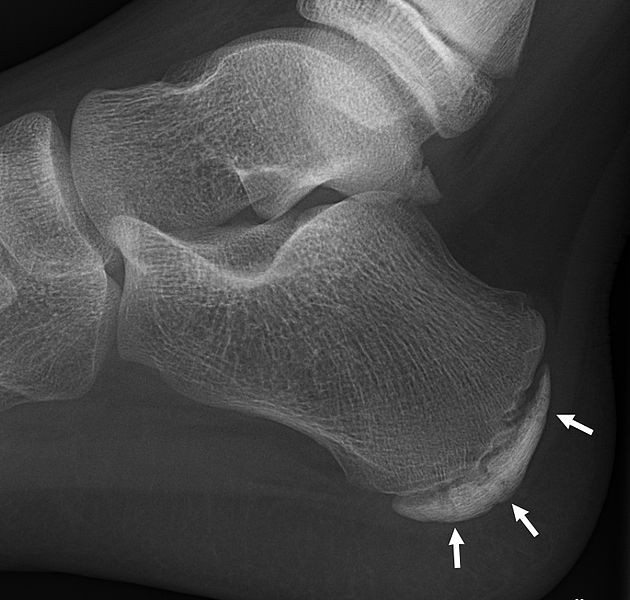 File:Sclerosis and fragmentation of the calcaneal apophysis.jpg